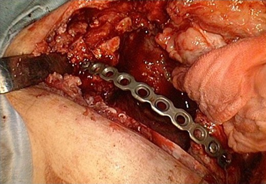 The fixation of fifth rib using titanium plate.