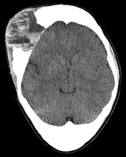 CT of head without contrast.