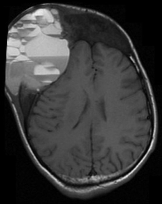 Axial T1 MRI of head.