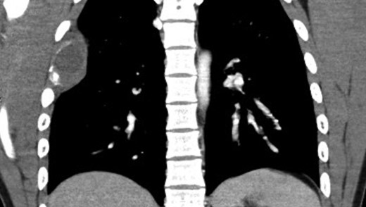 CT of chest with contrast.