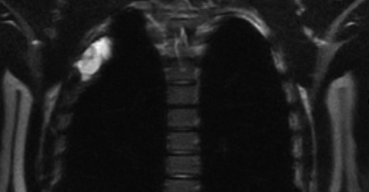 T2 SS-FSE MRI of chest.