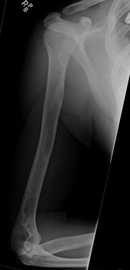 X-ray of humerus.