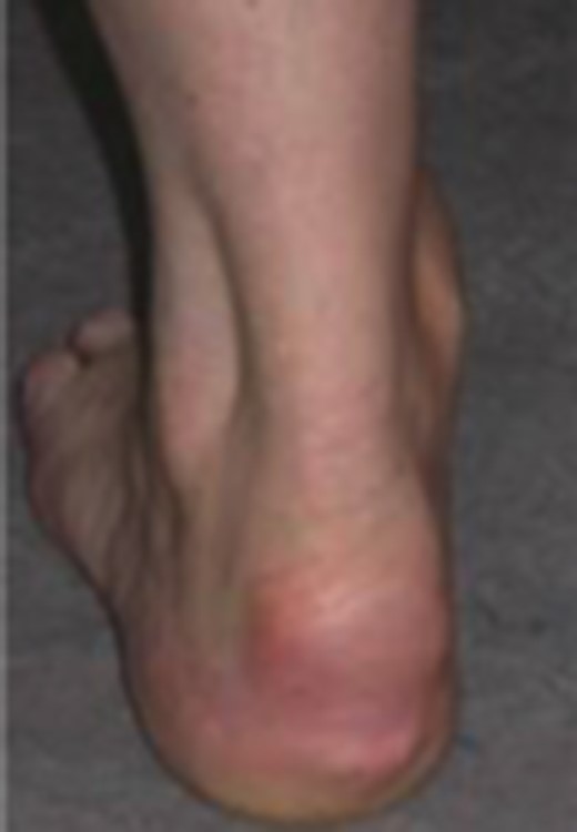 Photograph of patient’s heel.