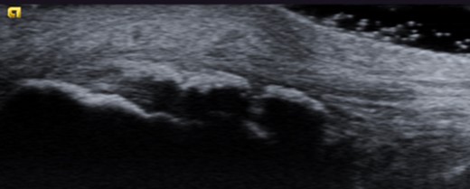 Ultrasound image of thickened subcutaneous bursa and bone formations in the distal Achilles.