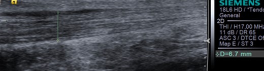 Ultrasound image of tendinopathy seen in distal Achilles.