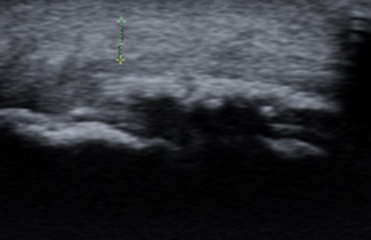 Ultrasound image of diffusely thickened subcutaneous bursa and underlying intra-tendinous bone formations.