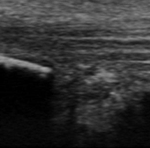 Ultrasound image of minor Haglund deformity with sharp edge. Enlarged retrocalcaneal bursa with appearance of bursal scar tissue formation.