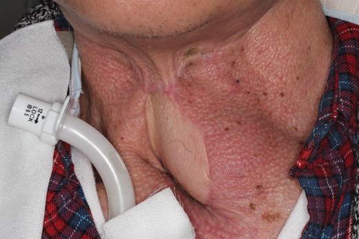 Unfavorable result following resurfacing around the tracheostoma. Cutaneous resurfacing around the tracheostoma was performed with a pectoralis major musculocutaneous flap to repair a pharyngocutaneous fistula. Since the bulky flap obstructs the tracheostomal opening, decannulation is impossible.