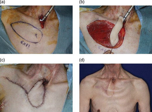 Pre-, intra- and postoperative photographs of Case 1. A 76-year-old man with repeated infections around the tracheostoma due to tracheoesophageal fistula following a failed tracheoesophageal puncture attempt. (a) New tracheostomy was planned with cutaneous resurfacing by a 6 × 13 cm IMAP flap based on the second perforator. (b) Elevated flap. (c) A 1/2 circumferential cutaneous portion surrounding the tracheostomy was reconstructed with the flap. (d) Six-month postoperative view.
