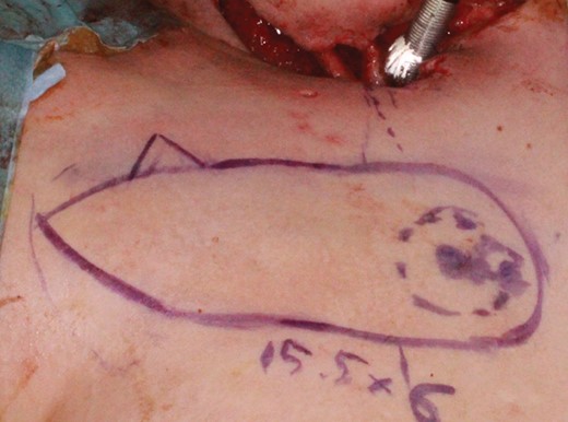 An intraoperative photograph of Case 2. A 25-year-old woman with skin necrosis of the neck and exposure of the carotid artery following surgical site infection. To cover the carotid artery and reconstruct neck skin surrounding the tracheostomy, a 15.5 × 6 cm IMAP flap was designed based on the second perforator.