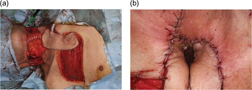 Intraoperative photographs of Case 3. A 72-year-old man with hypopharyngeal cancer underwent pharyngolaryngoesophagectomy, neck skin resection, bilateral neck dissection and free jejunal transfer. (a) A 16 × 7 cm IMAP flap was transferred with dual pedicles (second and third perforators) to reconstruct soft tissue surrounding the tracheostoma. (b) A slit was created in the distal flap to accept a tracheostoma circumferentially without compromising the blood supply.