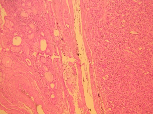 H&E ×100, original magnification. Tumor is shown to the right, circumscribed and surrounded by a thin fibrous capsule (arrows).
