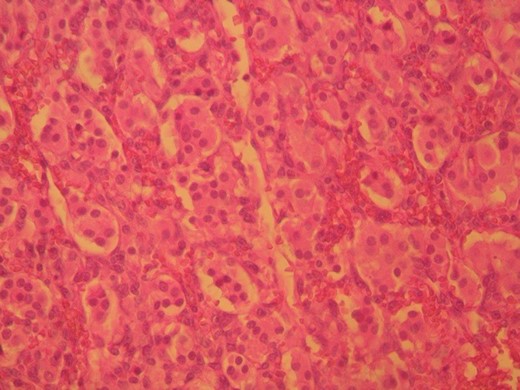 H&E ×400, original magnification. The tumor shows the characteristic ‘zellballen’ pattern.