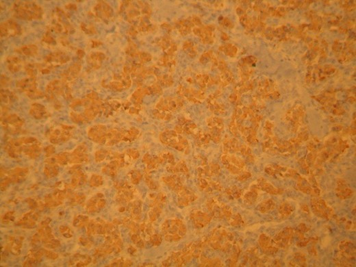 Chromogranin A. Positive staining of neoplastic cells.