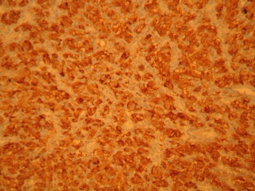 Synaptophysin. Positive staining of neoplastic cells.