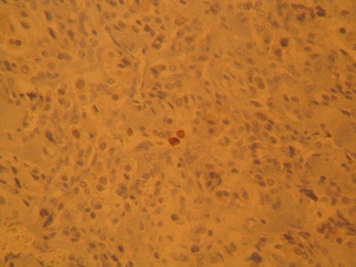 Thyroid paraganglioma, Ki67 proliferation marker. Positivity of occasional neoplastic cells.