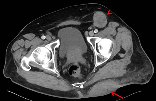 Computed tomography of pelvis. The left gluteal lesion with a foci of air (arrow) signifying possible infected versus necrotic material. Left inguinal lymphadenopathy also demonstrated (arrowhead).