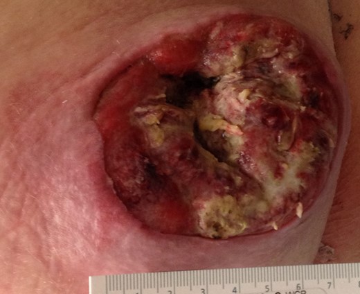 Left buttock lesion. Appearance of the wound following unroofing, drainage and incisional biopsy.