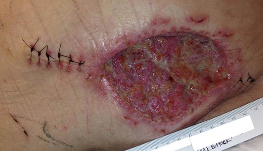 Postsurgical excision. Appearance of the excision site on postoperative day seven following partial closure with fasciocutaneous advancement flap and split-thickness skin grafting.