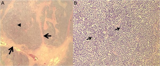 Histological results of excision. (A) ×10 Fibrotic cords (arrows) surrounding the MCC cells and central tumor necrosis (arrowhead). (B) ×40 Bland cell morphology (arrows) with a mix of fine, bland and powdery chromatin.