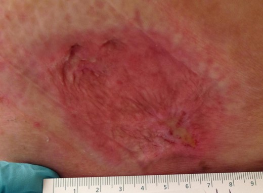 Healed wound. Appearance of the left buttock wound five months following complete MCC excision.
