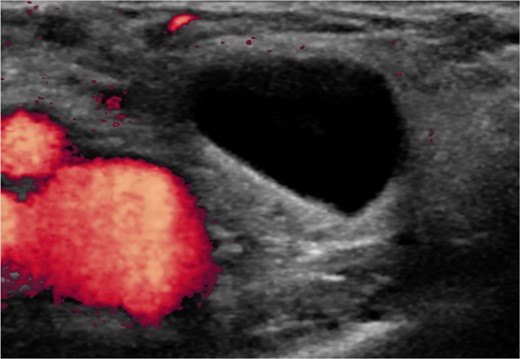 A thin-walled fluid filled sac medial to the femoral vessels diagnostic of a femoral hernia.