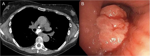 (A) Calcified subcarinal lymph node. (B) Obstructing endobronchial lesion on the medial wall of the right mainstem bronchus.
