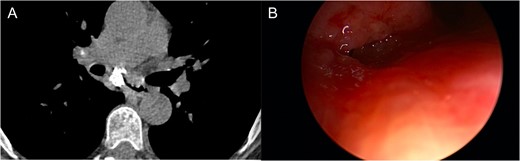 (A) CT scan revealing fistula between the right mainstem bronchus and esophagus. (B) Endobronchial view visualizing right mainstem defect.