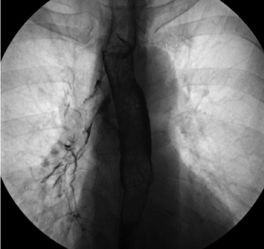 Esophagram revealing extravasation into the tracheobronchial tree.