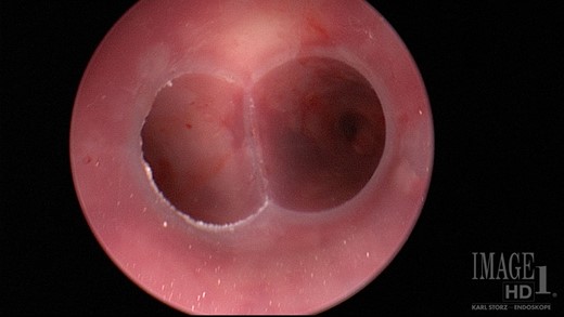Y-stent placement covering the proximal right mainstem fistu.