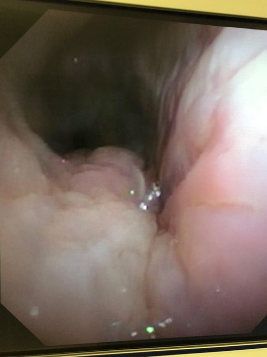 Healed right mainstem fistula 10 months after treatment.