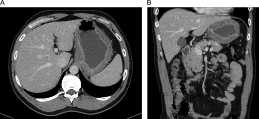 CT-scan of our patient at admission with widespread thickening of the gastric wall, without signs of perforation in a transversal (A) and coronal (B) coupe.