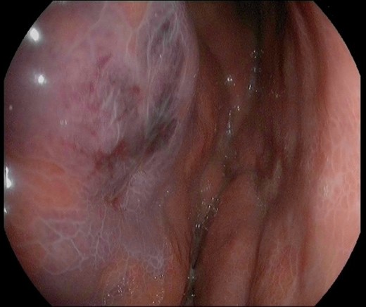 Image of the gastric mucosa during the esophageal-gastro-duodenoscopy with diffuse erythema and edema of the gastric wall.