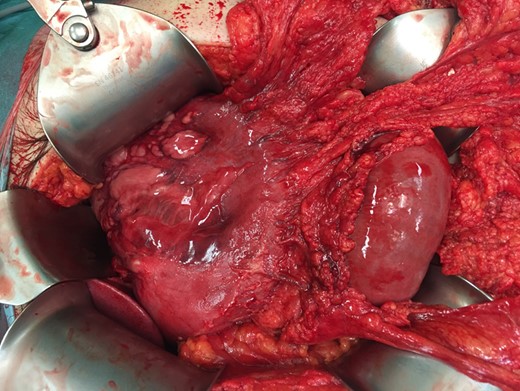 Peroperative image during laparotomy with dark red and diffuse gastric wall thickening. Some parts of the gastric wall are ischemic and have intact bullae on them.