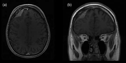 Initial brain MRI showing extra-axial mass in the right frontal part of anterior cranial fossa in (a) transverse and (b) coronal plain.