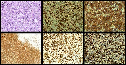 Microphotography of tumorous tissue with fibrous tissue of dural origin on the edge of the surgical material, measuring together 5 cm in greatest diameter: (a) hemalaun eosin staining, magnification of ×400; (b) immunohistological reactivity BLC6, magnification of ×400; (c) immunohistological reactivity CD20, magnification of ×400; (d) immunohistological reactivity CD45 LCA, magnification of ×100; (e) immunohistological reactivity CD79, magnification of ×400; and (f) proliferation index Ki67, magnification of ×400.