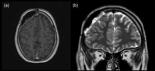 MRI scans of brain, 4 months postoperatively, revealing no recurrence of lymphoma in (a) transverse and (b) coronal plain.