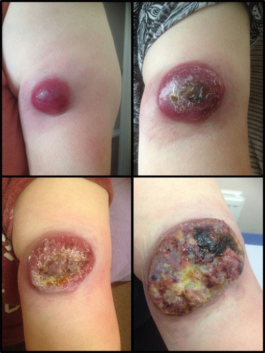 Represents the progression of the size of the cutaneous lesion over a few months.
