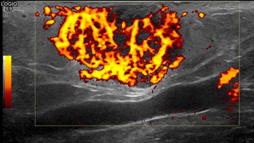 Shows the highly vascularized sonographic features of the mass on ultrasound scan.