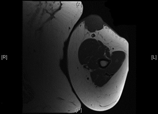 Shows the mass being superficial and subcutaneous without any underlying muscle involvement on magnetic resonance imaging.