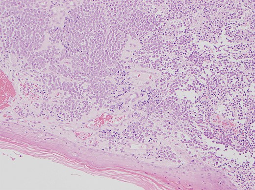 Shows the histology image of the biopsy sample with monotonous atypical round cells and hyperchromatic nuclei.