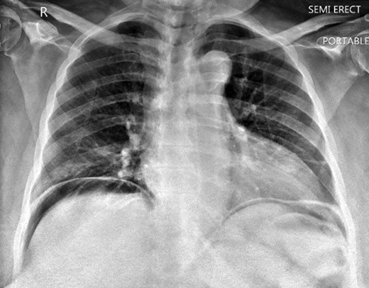 Chest x ray showing free air below the diaphragm.