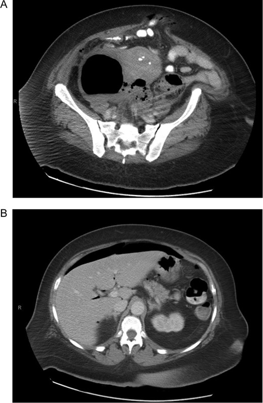 (A) Computer tomography showing pelvic collection. (B) Computer tomography showing pneumoperitoneum.