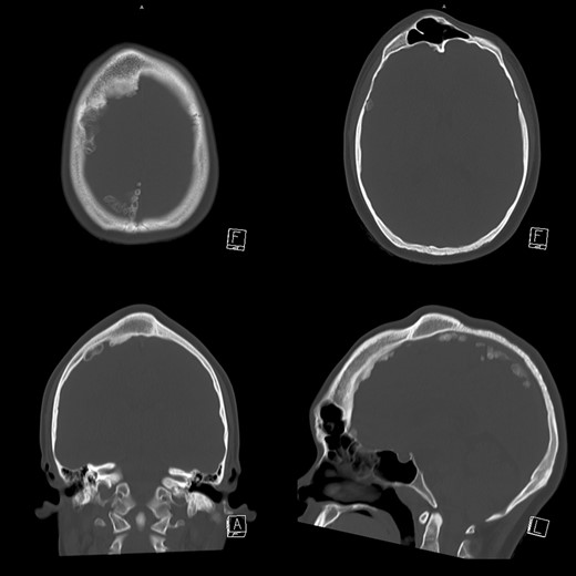 Slices of skull CT. Hypertrophy of right frontal and parietal bone is observed. Diploe of the hypertrophic part presented ground glass appearance. Frontal sinus was dilated without mucous hypertrophy. Intra-cranial calcification was also observed.