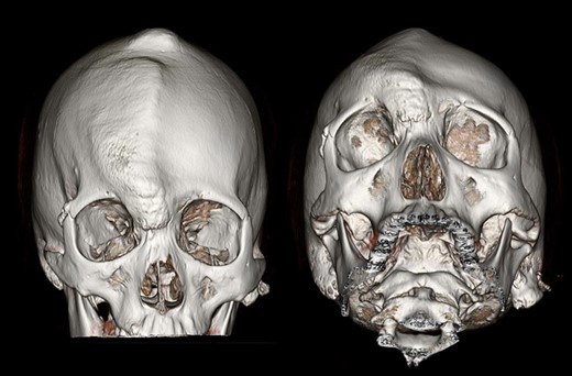 Three-dimensional CT of the patient’s skull. Protrusion of right frontal and parietal area was well observed.