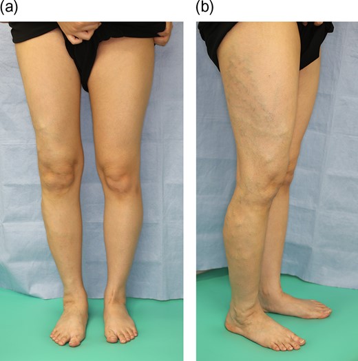 (a) Right knee is at higher than left. (b) Subdermal hyper-vascularity was observed on the lateral part of her right leg.
