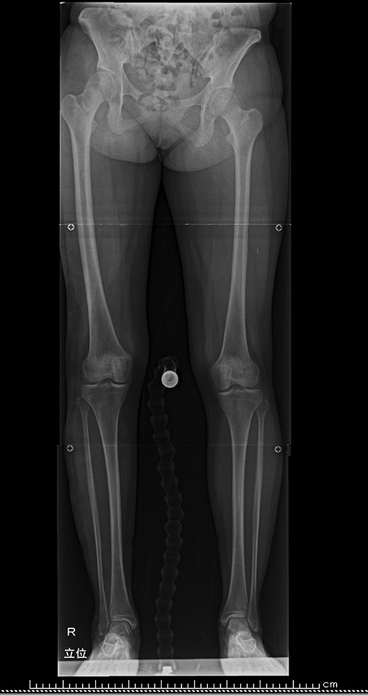 Standing radiograph of the lower extremities. Leg length discrepancy was 31 mm. Tibial length discrepancy was 21 mm.