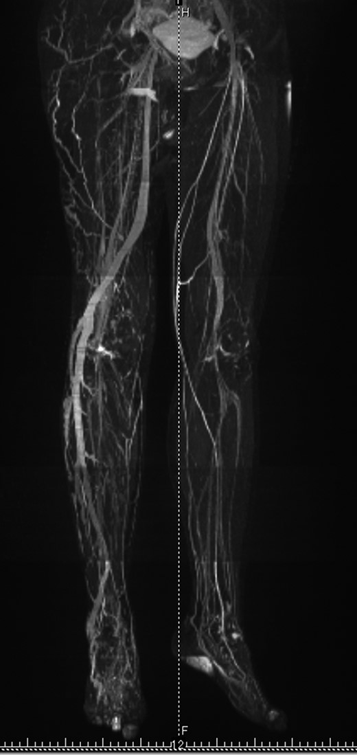 MRI venography of the lower extremities. Vascular density in the right leg is higher than in the left. Abnormally large calibered vessel runs from lateral part of the right lower leg to great saphenous vein.
