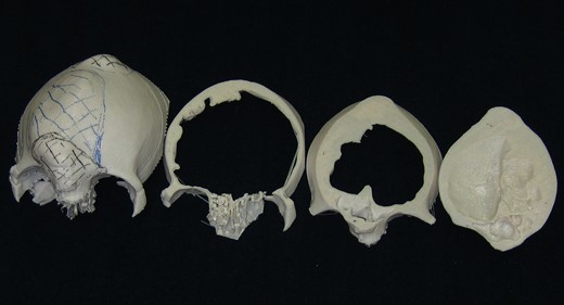 3D models made from CT data. Sliced models were also made to observe inner structure. They were referred during the surgery.