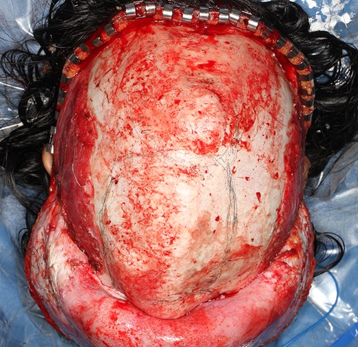 The scalp flap was raised subperiosteally. The picture is oriented the orbits and the nose downward. Protrusions on the cranium were observed.